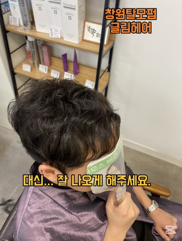 시술 후 — M자 탈모커버