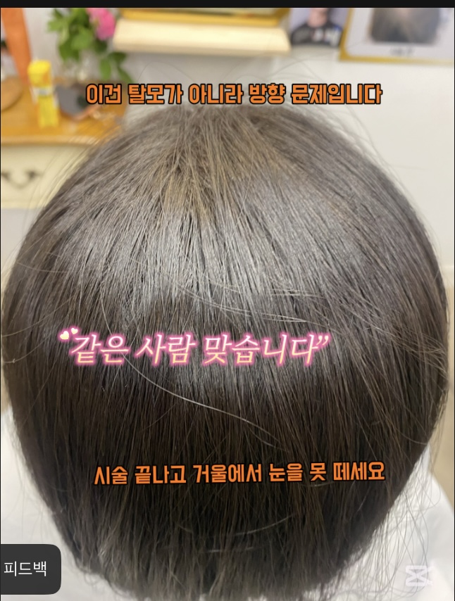 시술 후 — 정수리 볼륨 교정